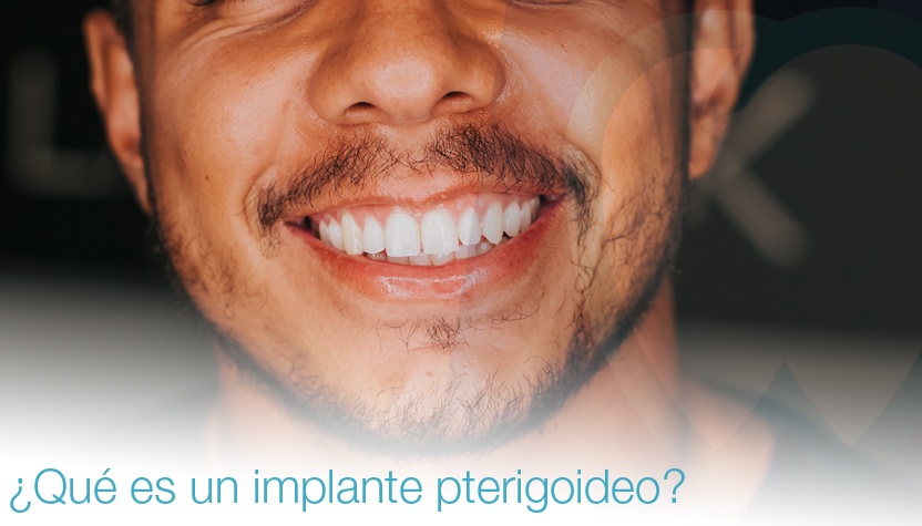 ¿Qué es un implante pterigoideo? Te lo contamos en Clínica Mallorca Dental